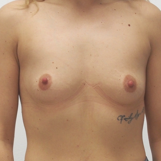 Klientka před a po zvětšení prsou. Použity byly kulaté implantáty o velikosti 340 mililitrů, extra vysoký profil. Vloženy byly podprsní rýhou pod sval.
Operatér: Prim. MUDr. Pavel Horyna
