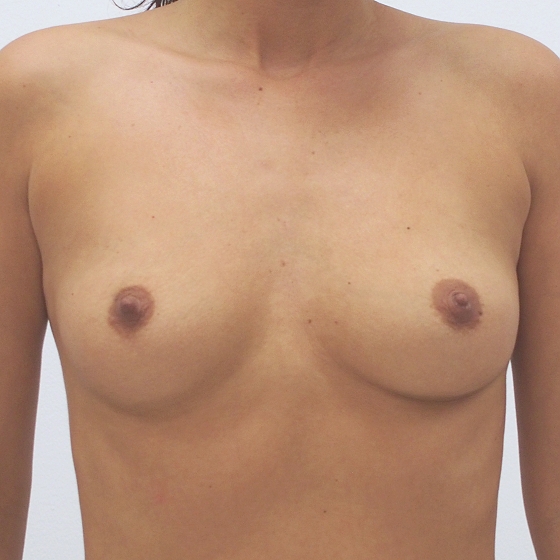 Klientka před a po zvětšení prsou. Použity byly kulaté implantáty o velikosti 255 mililitrů.
Operatér: Prim. MUDr. Pavel Horyna