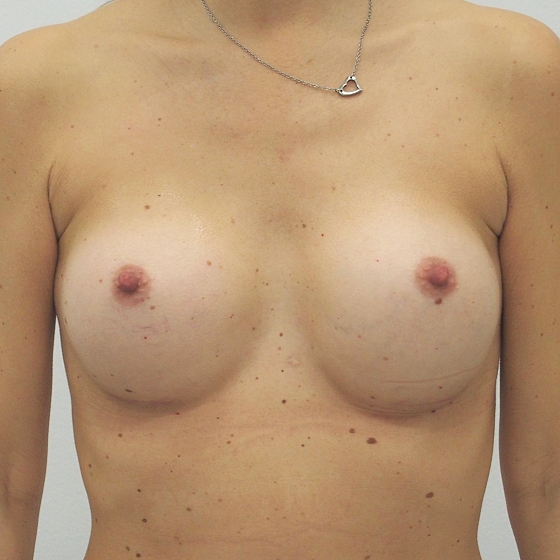 Klientka před a po zvětšení prsou. Použity byly kulaté implantáty o velikosti 360 mililitrů, vysoký profil. Vloženy byly podprsní rýhou pod sval.
Operatér: MUDr. Peter Ondrejka