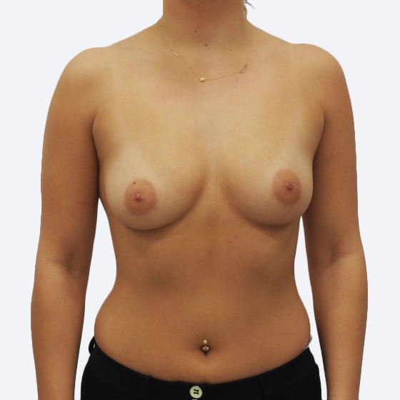 Klientka před a po zvětšení prsou. Použity byly kulaté implantáty o velikosti 335 mililitrů. Vloženy byly podprsní rýhou pod sval.
Operatér: MUDr. Peter Ondrejka