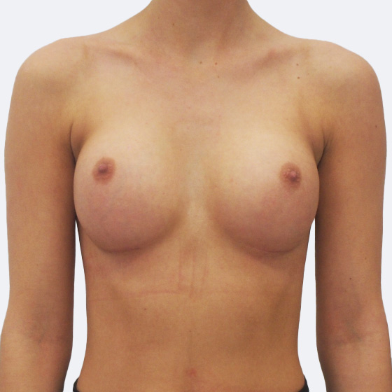 Klientka před a po zvětšení prsou. Použity byly kulaté implantáty o velikosti 295 mililitrů. Vloženy byly podprsní rýhou pod sval.
Operatér: MUDr. Peter Ondrejka