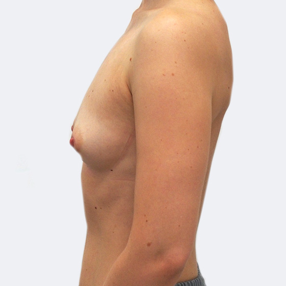 Klientka před a po zvětšení prsou. Použity byly kulaté implantáty o velikosti 285 mililitrů. Vloženy byly podprsní rýhou pod sval.
Operatér: MUDr. Peter Ondrejka