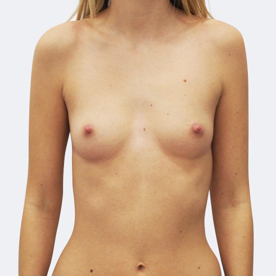 Klientka před a po zvětšení prsou. Použity byly kulaté implantáty o velikosti 375 mililitrů. Vloženy byly podprsní rýhou pod sval.
Operatér: MUDr. Peter Ondrejka
