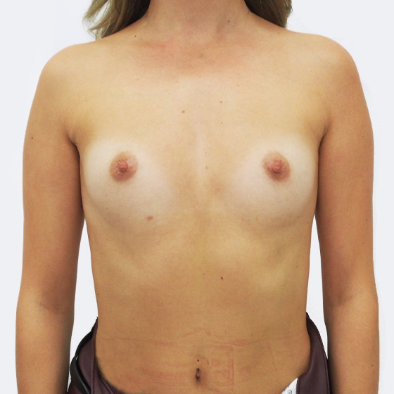 Klientka před a po zvětšení prsou. Použity byly kulaté implantáty o velikosti 275 mililitrů. Vloženy byly podprsní rýhou pod sval.
Operatér: MUDr. Peter Ondrejka