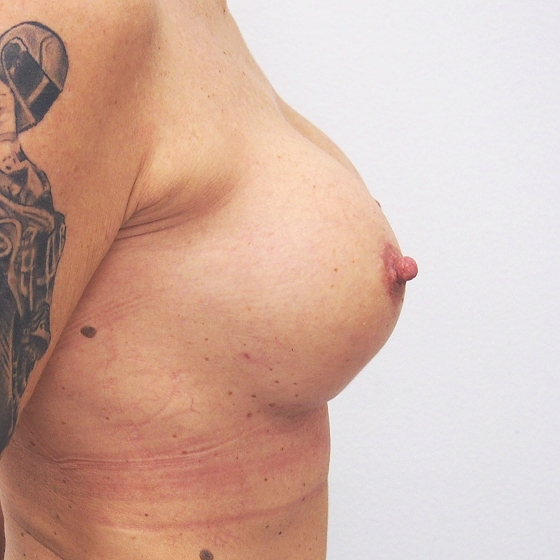 Klientka před a po zvětšení prsou. Použity byly kulaté implantáty o velikosti 275 mililitrů. Vloženy byly podprsní rýhou pod sval.
Operatér: MUDr. Peter Ondrejka