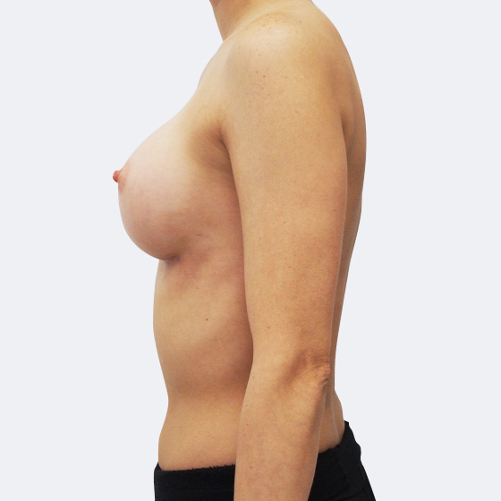 Klientka před a po zvětšení prsou. Použity byly kulaté implantáty o velikosti 365 mililitrů. Vloženy byly podprsní rýhou pod sval.
Operatér: MUDr. Peter Ondrejka