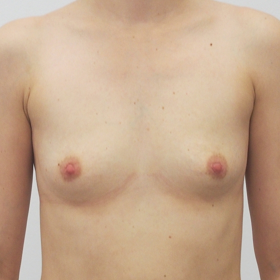 Klientka před a po zvětšení prsou. Použity byly kulaté implantáty o velikosti 315 mililitrů. Vloženy byly podprsní rýhou pod sval.
Operatér: MUDr. Peter Ondrejka