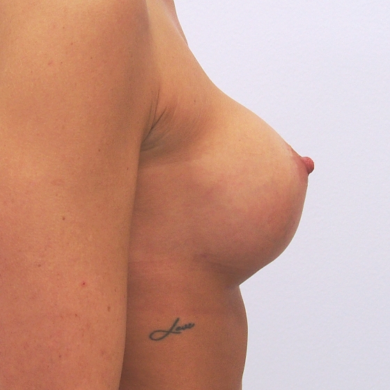 Klientka před a po zvětšení prsou. Použity byly kulaté implantáty o velikosti 325 mililitrů. Vloženy byly podprsní rýhou pod sval.
Operatér: MUDr. Peter Ondrejka