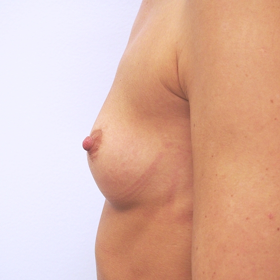 Klientka před a po zvětšení prsou. Použity byly kulaté implantáty o velikosti 325 mililitrů. Vloženy byly podprsní rýhou pod sval.
Operatér: MUDr. Peter Ondrejka