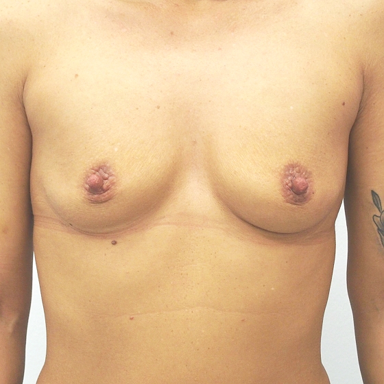 Klientka před a po zvětšení prsou. Použity byly kkapkovité implantáty o velikosti 345 mililitrů. Vloženy byly podprsní rýhou pod sval.
Operatér: MUDr. Peter Ondrejka