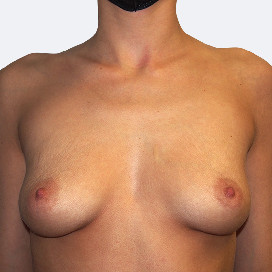 Klientka před a po zvětšení prsou. Použity byly kulaté implantáty o velikosti 375 mililitrů, vysoký profil. Vloženy byly podprsní rýhou pod sval.
Operatér: Prim. MUDr. Petr Pachman