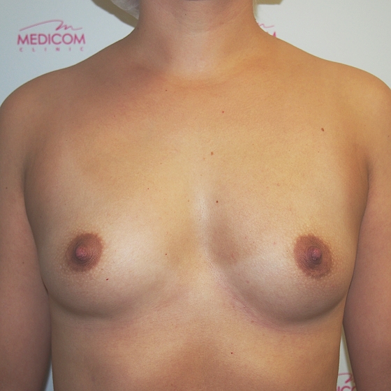 Klientka před a po zvětšení prsou. Použity byly kulaté implantáty o velikosti 300 mililitrů, vysoký profil. Vloženy byly podprsní rýhou pod sval.
Operatér: Prim. MUDr. Petr Pachman