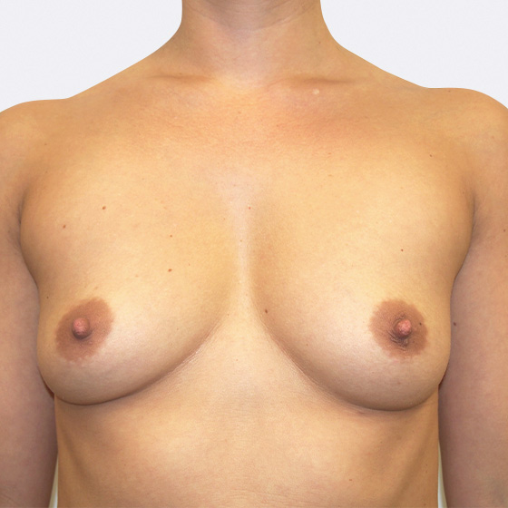 Klientka před a po zvětšení prsou. Použity byly kulaté implantáty o velikosti 325 a 350 mililitrů. Vloženy byly podprsní rýhou pod sval.
Operatér: Prim. MUDr. Petr Pachman