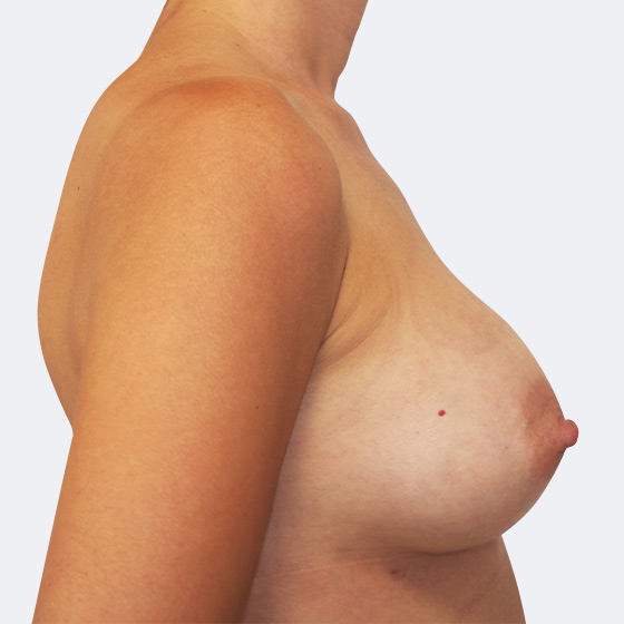Klientka před a po zvětšení prsou. Použity byly kulaté implantáty o velikosti 300 mililitrů, vysoký profil. Vloženy byly podprsní rýhou pod sval.
Operatér: Prim. MUDr. Petr Pachman