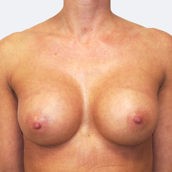 Klientka před a po zvětšení prsou. Použity byly kulaté implantáty o velikosti 275 a 300 mililitrů. Vloženy byly podprsní rýhou pod sval.
Operatér: Prim. MUDr. Petr Pachman
