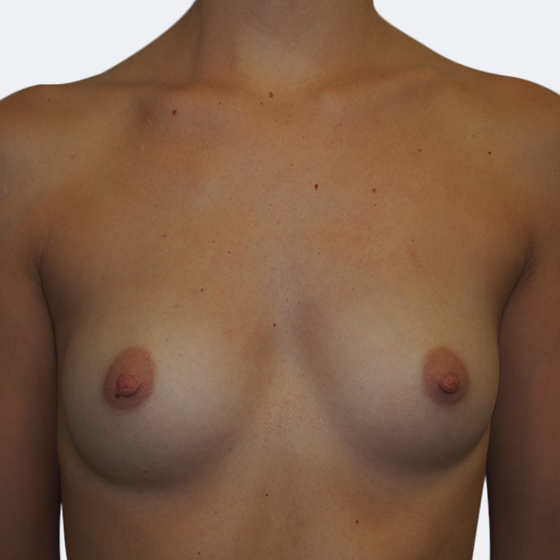 Klientka před a po zvětšení prsou. Použity byly kulaté implantáty o velikosti 275 mililitrů, vysoký profil. Vloženy byly podprsní rýhou pod sval.
Operatér: Prim. MUDr. Petr Pachman