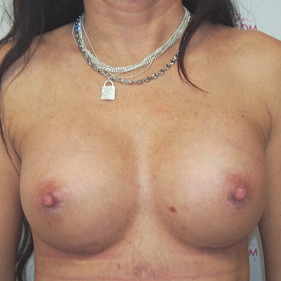 Klientka před a po zvětšení prsou. Použity byly kulaté implantáty o velikosti 275 mililitrů. Vloženy byly podprsní rýhou pod sval.
Operatér: Prim. MUDr. Petr Pachman
