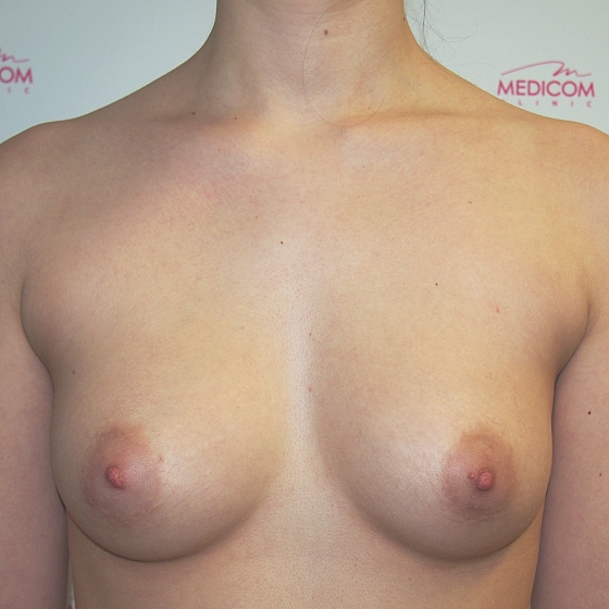 Klientka před a po zvětšení prsou. Použity byly kulaté implantáty o velikosti 350 mililitrů, vysoký profil. Vloženy byly podprsní rýhou pod sval.
Operatér: Prim. MUDr. Petr Pachman