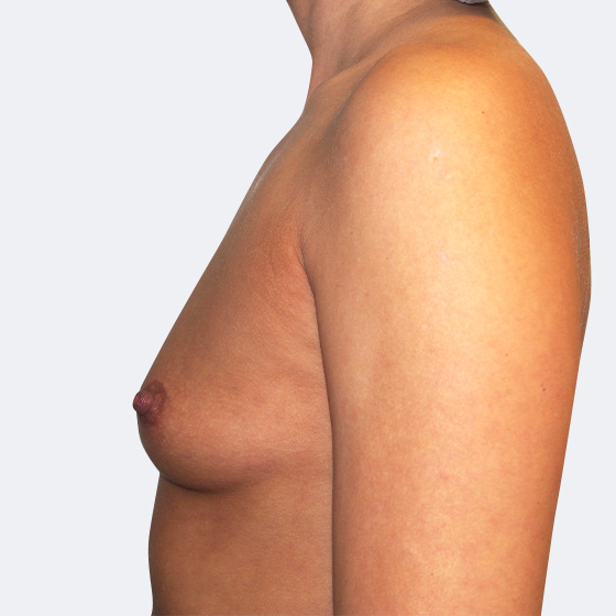 Klientka před a po zvětšení prsou. Použity byly kulaté implantáty o velikosti 325 mililitrů, vysoký profil. Vloženy byly podprsní rýhou pod sval.
Operatér: Prim. MUDr. Petr Pachman