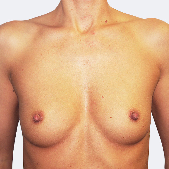 Klientka před a po zvětšení prsou. Použity byly kulaté implantáty o velikosti 350 mililitrů, vysoký profil. Vloženy byly podprsní rýhou pod sval.
Operatér: Prim. MUDr. Petr Pachman