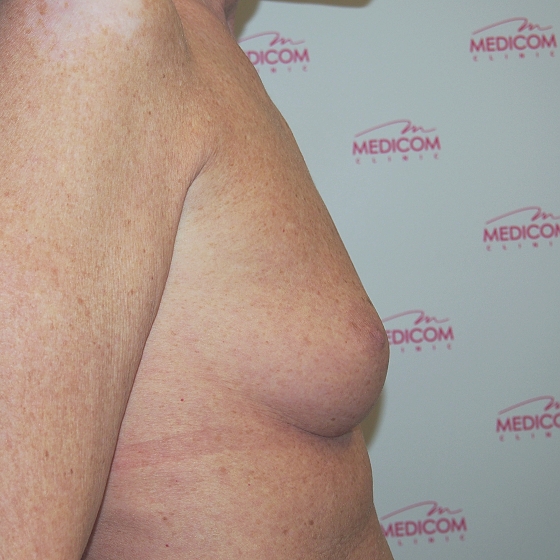 Klientka před a po zvětšení prsou. Použity byly kulaté implantáty o velikosti 325 mililitrů. Vloženy byly podprsní rýhou pod sval.
Operatér: Prim. MUDr. Petr Pachman