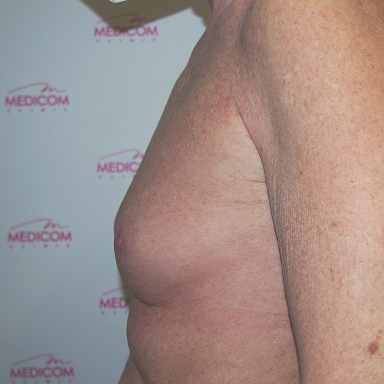 Klientka před a po zvětšení prsou. Použity byly kulaté implantáty o velikosti 325 mililitrů. Vloženy byly podprsní rýhou pod sval.
Operatér: Prim. MUDr. Petr Pachman