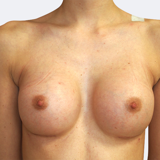 Klientka před a po zvětšení prsou. Použity byly kulaté implantáty o velikosti 275 mililitrů, vysoký profil. Vloženy byly podprsní rýhou pod sval.
Operatér: Prim. MUDr. Petr Pachman