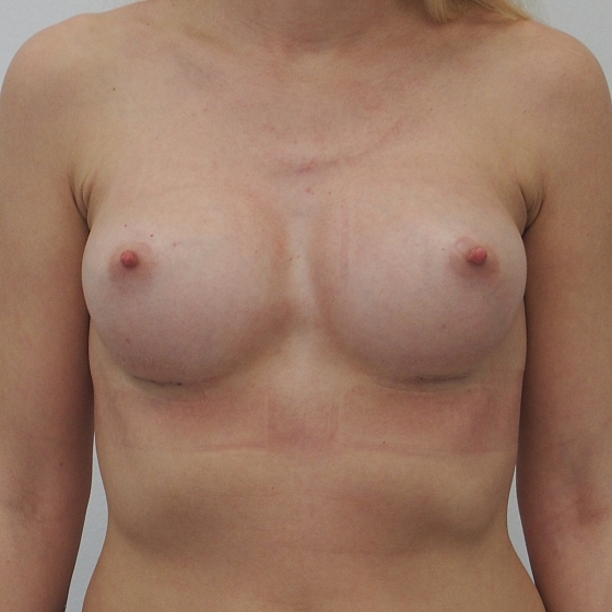 Klientka před a po zvětšení prsou. Použity byly kulaté implantáty, velikost 220ml., střední profil. Vloženy byly podprsní rýhou pod sval.
Operatér: MUDr. Petr Šuk