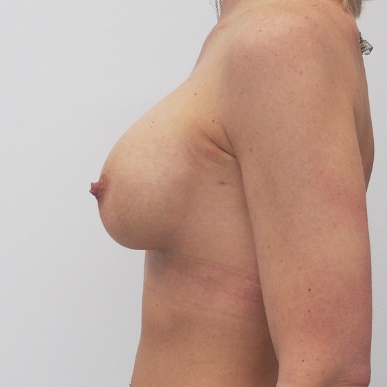 Klientka před a po zvětšení prsou. Použity byly kapkovité implantáty, velikost 395ml. 
Operatér: MUDr. Petr Šuk