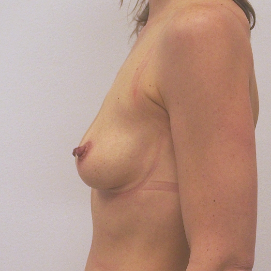 Klientka před a po zvětšení prsou. Použity byly kapkovité implantáty, velikost 395ml. 
Operatér: MUDr. Petr Šuk