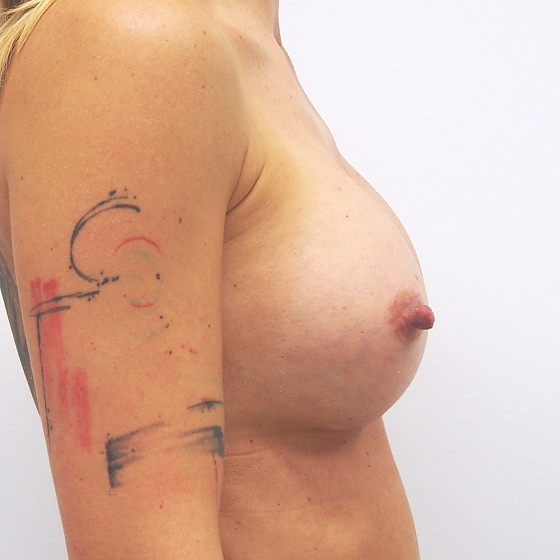 Klientka před a po zvětšení prsou. Použity byly anatomické implantáty, velikost 350ml. 
Operatér: MUDr. Petr Šuk