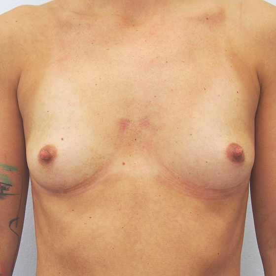 Klientka před a po zvětšení prsou. Použity byly anatomické implantáty, velikost 350ml. 
Operatér: MUDr. Petr Šuk