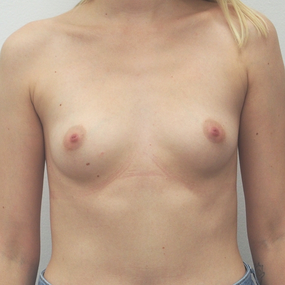 Klientka před a po zvětšení prsou. Použity byly anatomické implantáty, velikost 295ml. Vloženy byly podprsní rýhou pod sval.
Operatér: MUDr. Petr Šuk