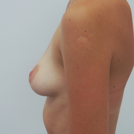Klientka před a po zvětšení prsou. Použity byly kapkovité implantáty, velikost 180 a 195ml. 
Operatér: MUDr. Petr Šuk
