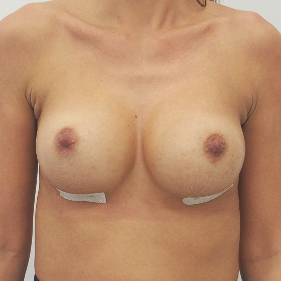Klientka před a po zvětšení prsou. Použity byly kulaté implantáty, velikost 325ml. Vloženy byly podprsní rýhou pod sval.
Operatér: MUDr. Petr Šuk