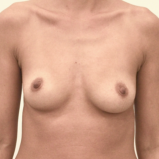 Klientka před a po zvětšení prsou. Použity byly kulaté implantáty, velikost 325ml. Vloženy byly podprsní rýhou pod sval.
Operatér: MUDr. Petr Šuk