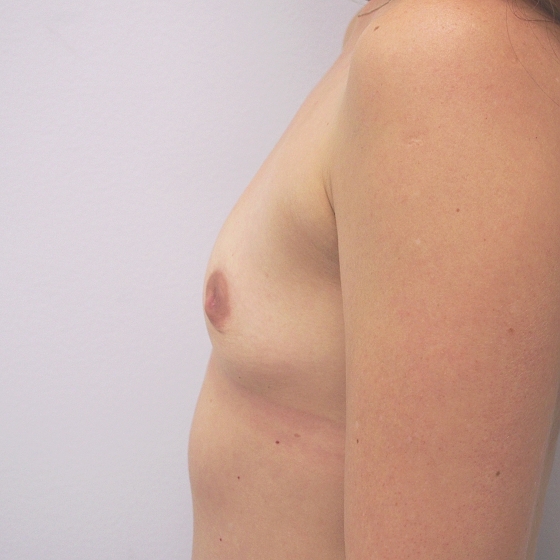 Klientka před a po zvětšení prsou. Použity byly kulaté implantáty, velikost 200ml. 
Operatér: MUDr. Petr Šuk