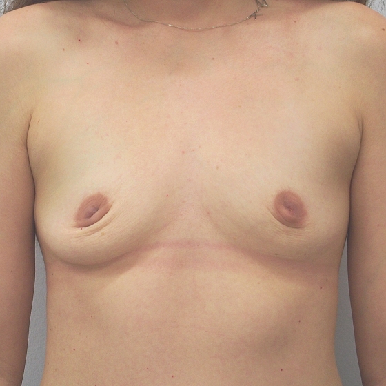 Klientka před a po zvětšení prsou. Použity byly kulaté implantáty, velikost 200ml. 
Operatér: MUDr. Petr Šuk