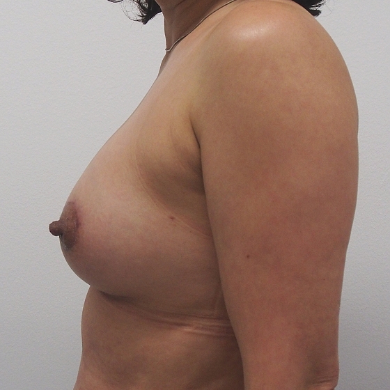 Klientka před a po periareolární mammaplastice s augmentací. Použity byly anatomické polyuretanové implantáty, velikost 220 ml. 
Operatér: MUDr. Petr Šuk