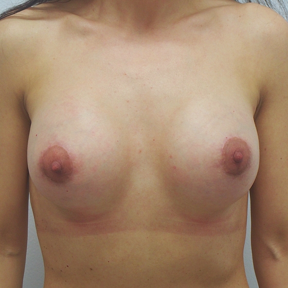 Klientka před a po augmentaci tuberózních prsou. Použity byly anatomické polyuretanové implantáty německé značky o velikosti 315 mililitrů. Vloženy byly podprsní rýhou pod sval.
Operatér: MUDr. Petros Christodoulou