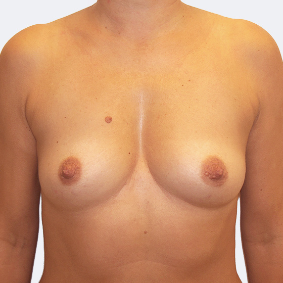 Klientka před a po zvětšení prsou. Použity byly kulaté implantáty o velikosti 400 mililitrů. Vloženy byly podprsní rýhou pod sval.