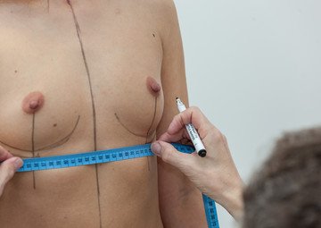 Průběh operace - Paní Jitka - zvětšení prsou