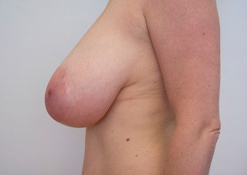 Průběh operace - Paní Jana - zmenšení prsou
