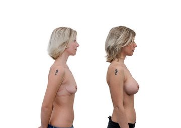 Průběh operace - Paní Kateřina - zvětšení prsou