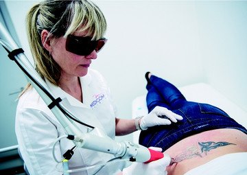 Průběh operace - Paní Jana - odstranění tetování 