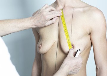 Průběh operace - Paní Jaroslava - zvětšení prsou s modelací 