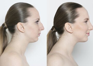 Průběh operace - Slečna Natálie - Plastická operace nosu
