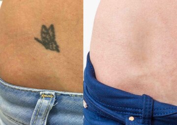 Průběh operace - Paní Karolína - odstranění tetování
