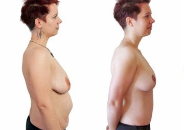 Průběh operace - Paní Lenka - modelace prsou