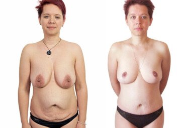 Průběh operace - Paní Lenka - modelace prsou